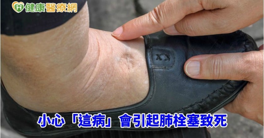 單腳腫脹不單純！　小心「這病」會引起肺栓塞致死